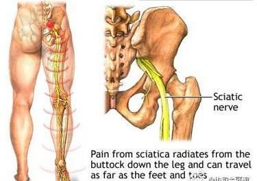 腰间盘突出怎么治疗,神经压迫引起的腿疼应该如何缓解