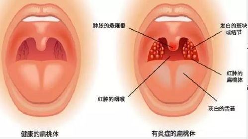 尽头牙发炎（预防和治疗方法）