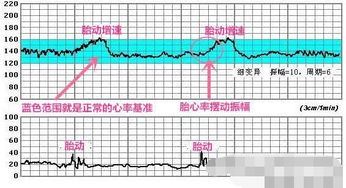 胎心率为140是正常的吗？详解胎心监护知识