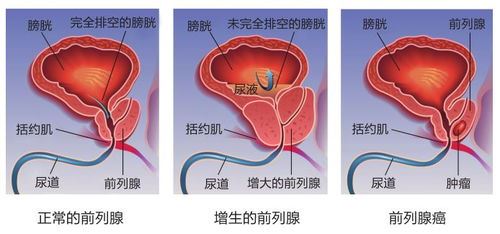 前列腺钙化的症状和治疗方法,前列腺钙化的危害及预防措施