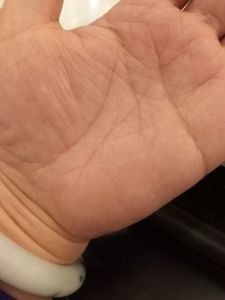 如何抑制手心痒的烦恼