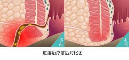 肛瘘的全面治疗方案与注意事项