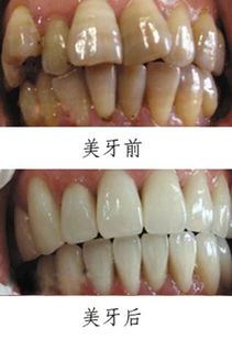 解决四环素牙问题的有效方法与技巧