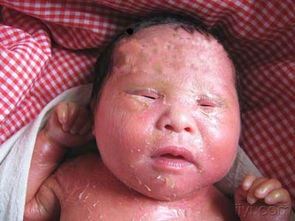 火棉胶婴儿是怎么引起的，常见的火棉胶婴儿症状及治疗方法