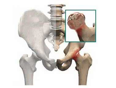 股骨头坏死症状及治疗方法详解