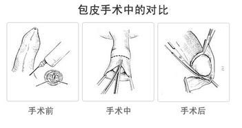 切割包皮需要多少钱（了解男性包皮手术的费用）