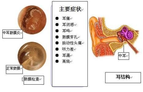 中耳炎手术费用多少,中耳炎手术需要注意什么