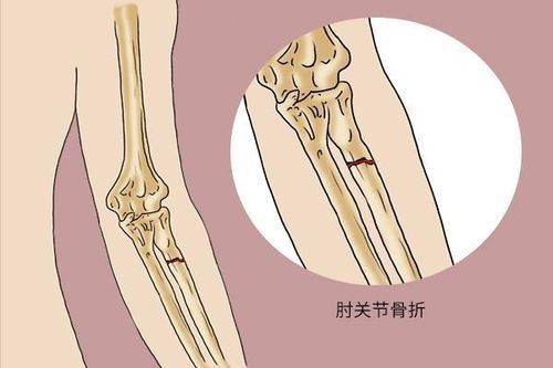 骨折了吃什么能加速康复？