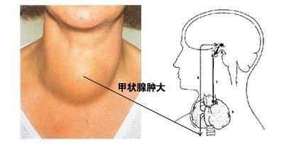 甲状腺亢进的症状与治疗方法详解