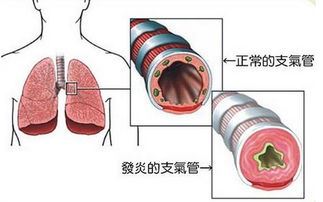 哮喘性支气管炎（症状治疗与预防）