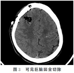 巨脑回畸形是什么（探究巨脑回畸形症状及治疗方法）