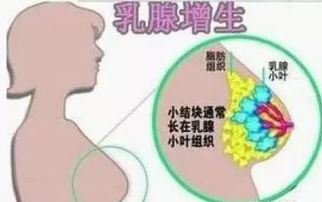 如何有效预防和治疗增生结节的方法探究