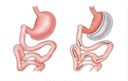 胃切除手术：一种有效的减肥方式