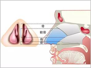 鼻中隔弯曲的症状和治疗方法,如何判断鼻中隔是否弯曲