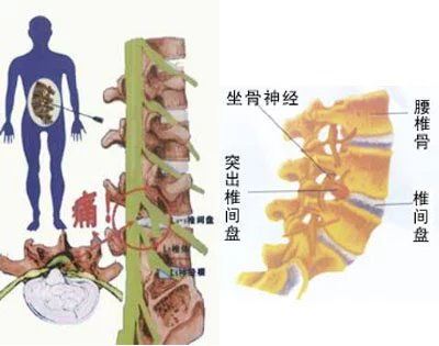 如何正确治疗腰椎间盘突出症状