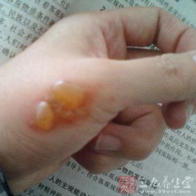 烫伤起泡怎么办（正确的处理方法和护理）