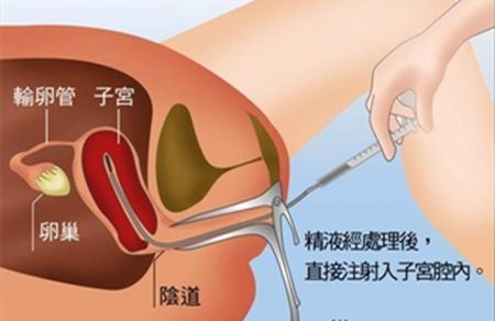 人工助孕方法有哪些注意事项？