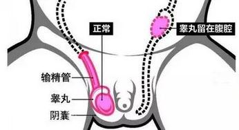 隐睾手术的费用及注意事项解析