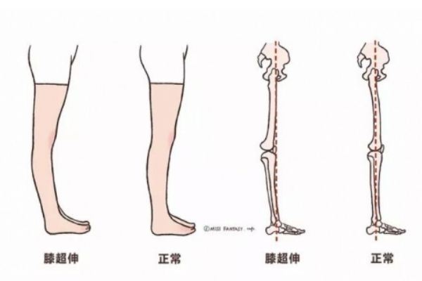 膝盖超伸怎么矫正 如何正确处理膝超伸