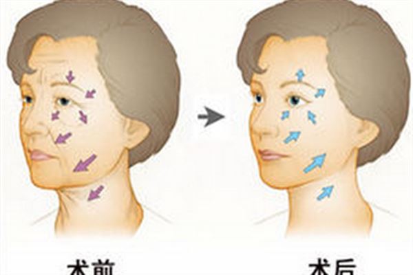 注射除皱针多少钱一针 除皱针的价格是多少钱