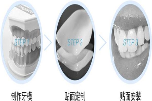 牙齿贴片的副作用是什么 牙齿贴片的危害是什么