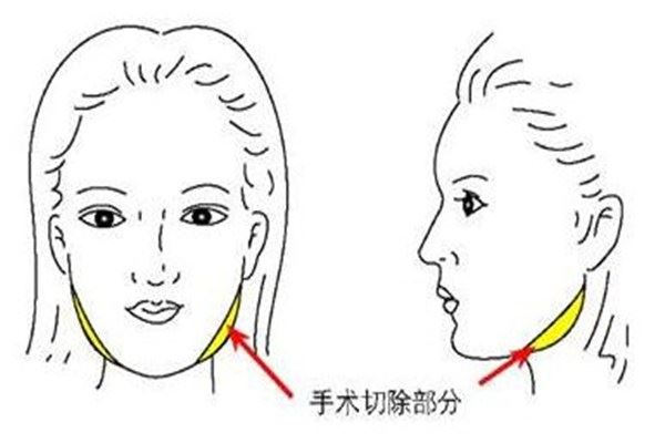 什么人适合下颌角整形手术 下颌角整形手术多久能消肿