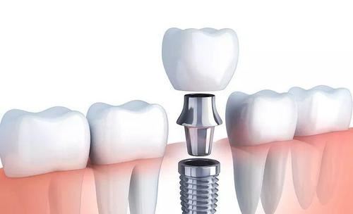 种植牙齿多少钱一颗 种植牙齿的价格受什么影响
