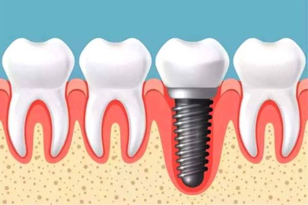 种植牙齿二期几天能拆线 种植牙齿多久能好