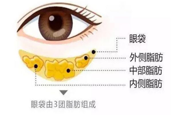 韩式去眼袋有痛感吗 韩式去眼袋会打麻药吗