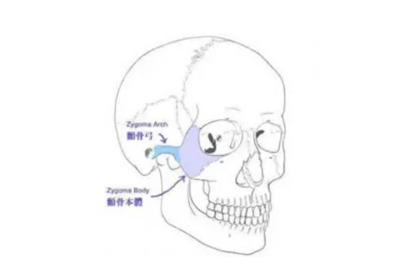 颧骨内推手术多少钱啊 颧骨内推后遗症