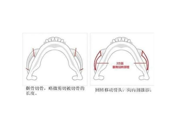 颧骨内推的钉子需要取出吗 颧骨内推是几级手术