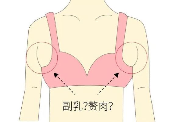 副乳切除手术会有疤痕吗 副乳切除手术怎么才能看不到疤痕