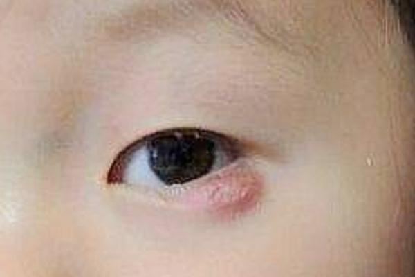 宝宝眼睛长了麦粒肿怎么办 宝宝长麦粒肿的原因